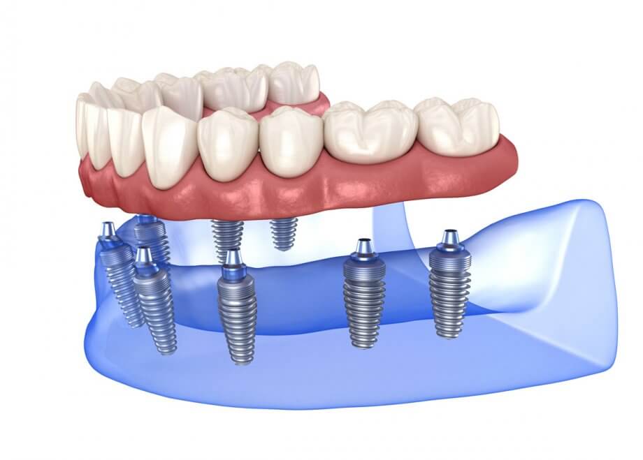 Dental Implants